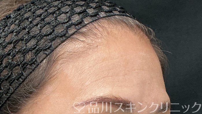 症例NO.75222のBEFORE写真