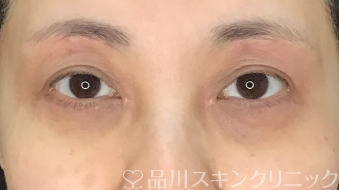 症例NO.70873のAFTER写真