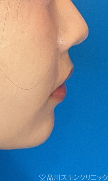 症例NO.74487のAFTER写真