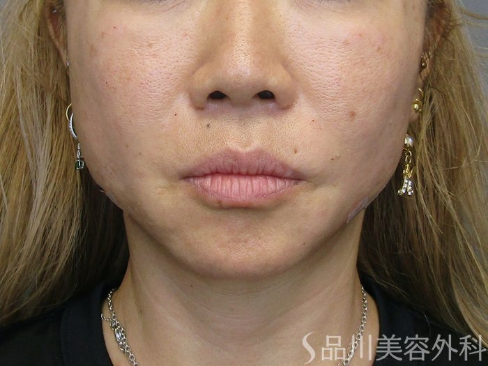 症例NO.75204のAFTER写真