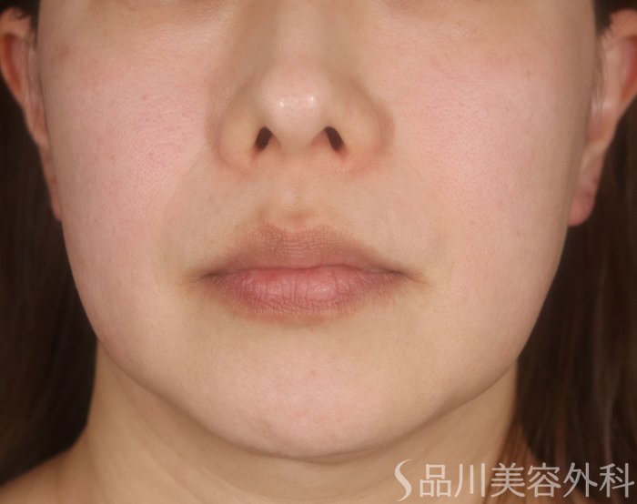 症例NO.73065のBEFORE写真