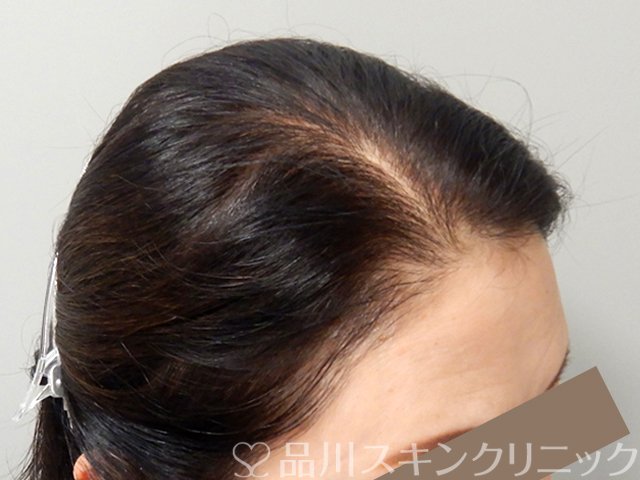 症例NO.70455のAFTER写真