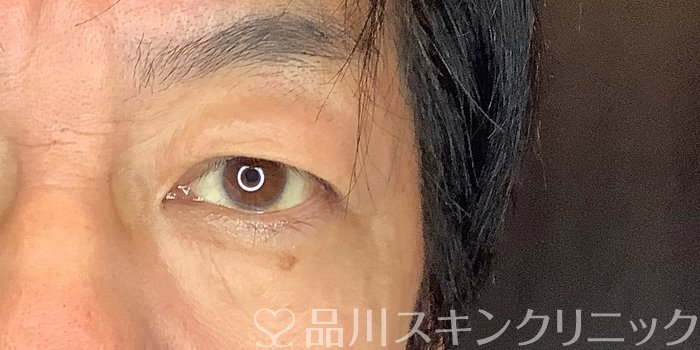 症例NO.67641のBEFORE写真