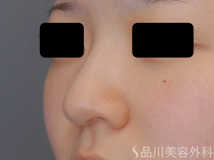 症例NO.71071のBEFORE写真