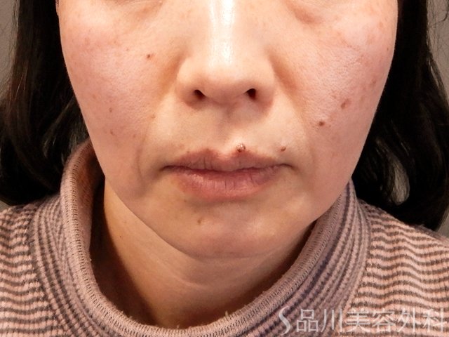 症例NO.70489のBEFORE写真