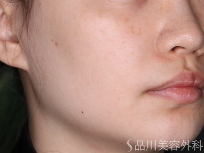 症例NO.73574のAFTER写真