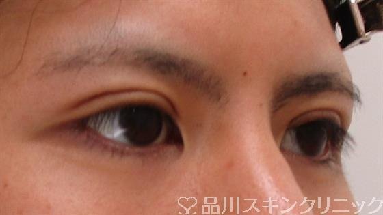 症例NO.42339のAFTER写真