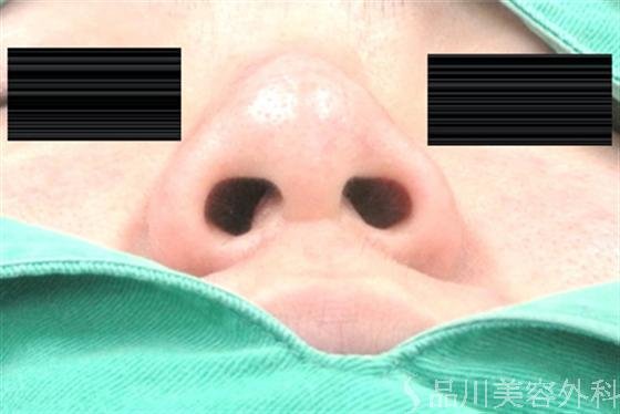 症例NO.15377のBEFORE写真