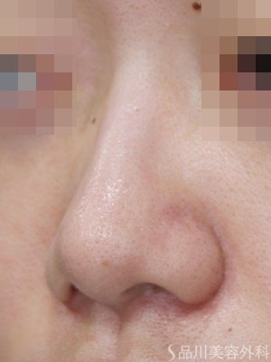 症例NO.70909のAFTER写真