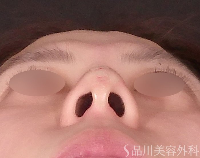 症例NO.70471のAFTER写真