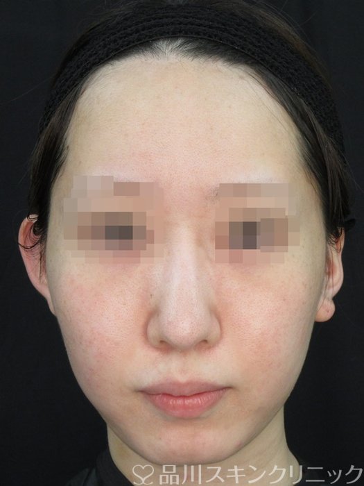 症例NO.73176のAFTER写真