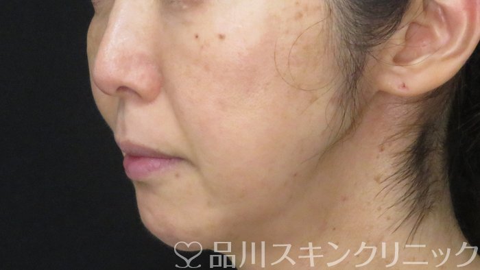 症例NO.71744のAFTER写真