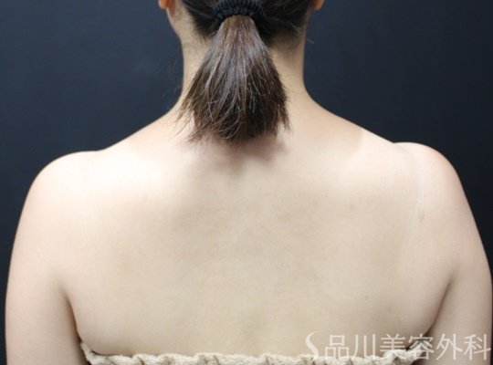 症例NO.65417のAFTER写真