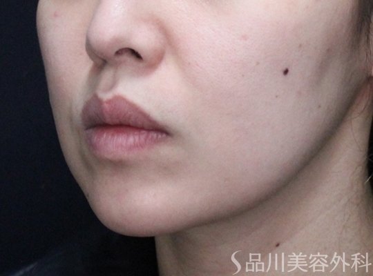 症例NO.73334のBEFORE写真