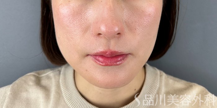 症例NO.70651のAFTER写真