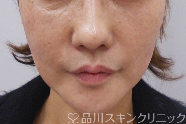 症例NO.69671のAFTER写真