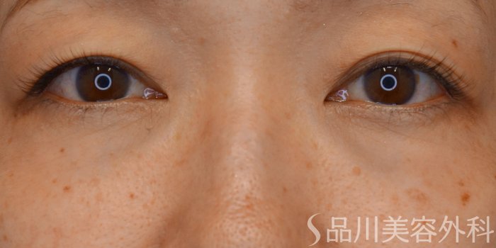 症例NO.71746のBEFORE写真