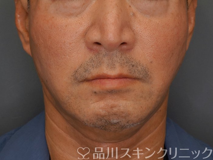 症例NO.73899のAFTER写真