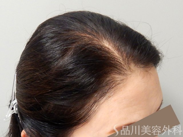 症例NO.70455のAFTER写真