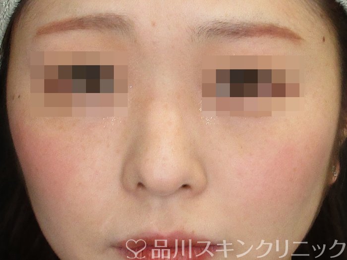症例NO.74077のBEFORE写真
