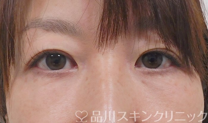 症例NO.63027のBEFORE写真