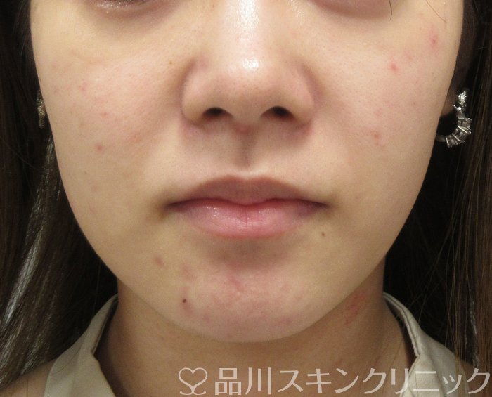 症例NO.74762のBEFORE写真