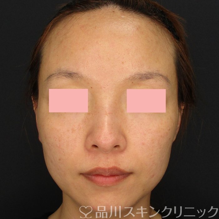 症例NO.71417のBEFORE写真