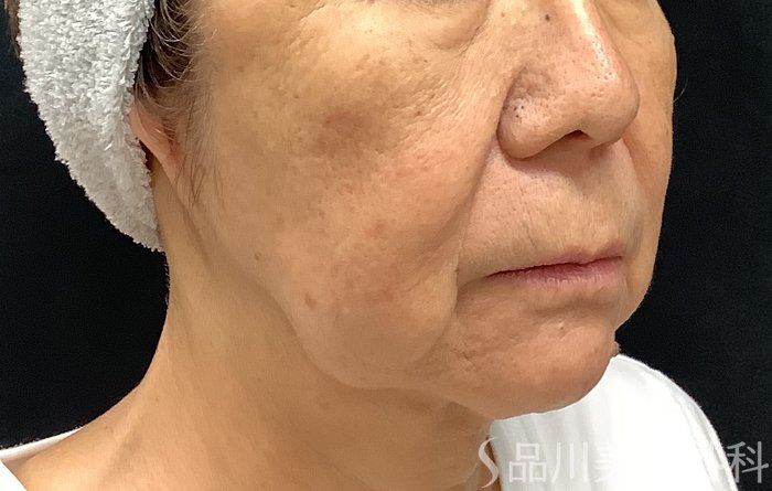 症例NO.67983のBEFORE写真