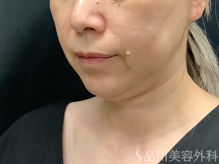 症例NO.75348のBEFORE写真