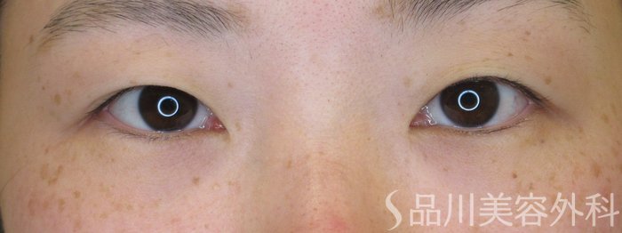 症例NO.72091のBEFORE写真