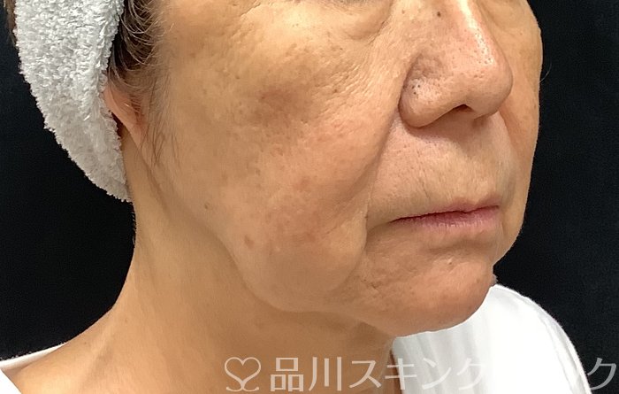 症例NO.67983のBEFORE写真
