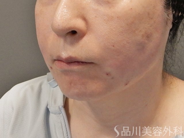 症例NO.75202のAFTER写真