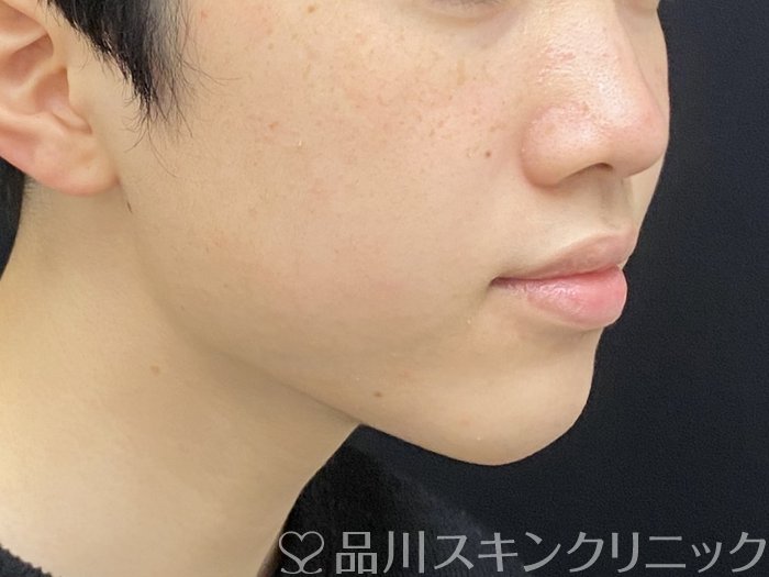 症例NO.73946のAFTER写真