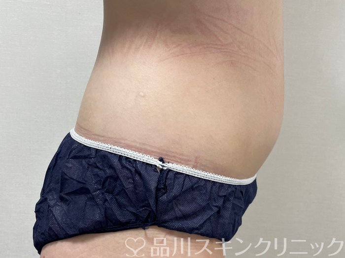 症例NO.74485のBEFORE写真