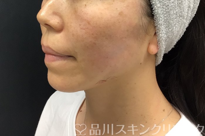 症例NO.71279のAFTER写真