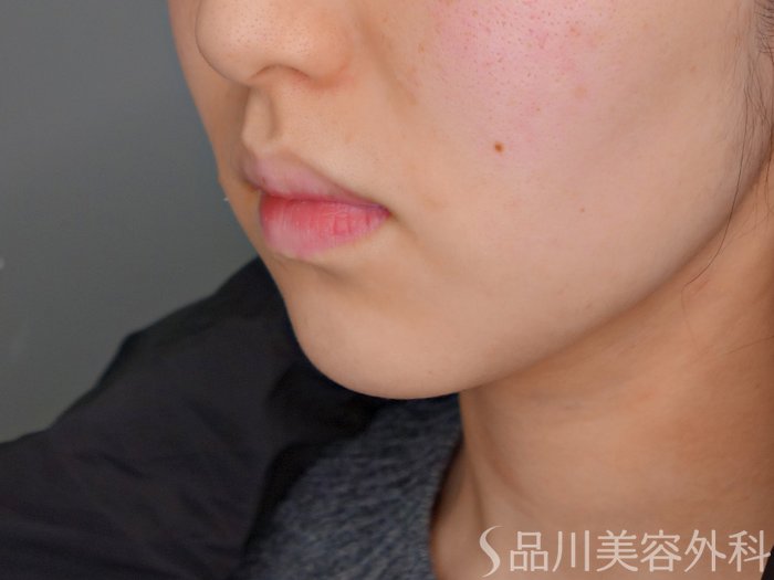症例NO.69829のBEFORE写真