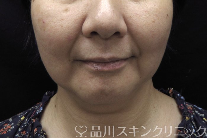 症例NO.74457のBEFORE写真