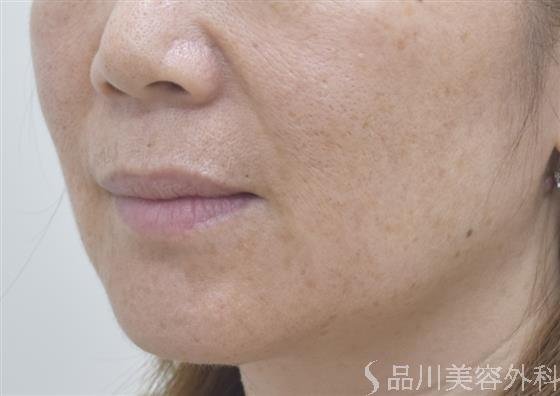 症例NO.46121のBEFORE写真