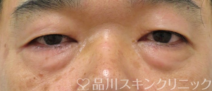 症例NO.75026のBEFORE写真