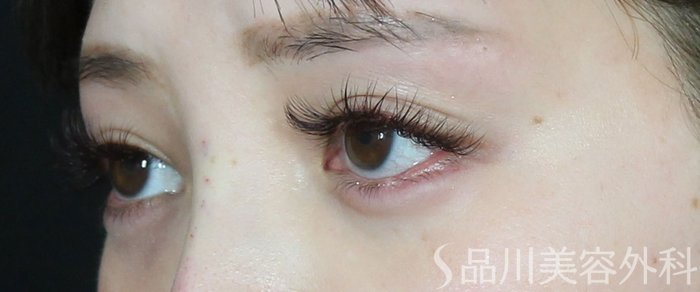 症例NO.73423のAFTER写真