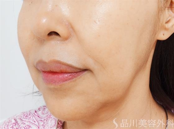 症例NO.24293のBEFORE写真