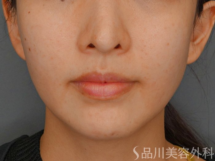 症例NO.73712のBEFORE写真