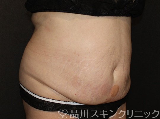 症例NO.74430のAFTER写真
