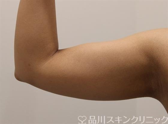 症例NO.48971のBEFORE写真
