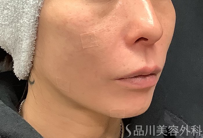 症例NO.69485のAFTER写真