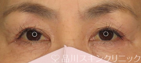 症例NO.71061のAFTER写真