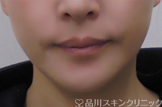 症例NO.40288のAFTER写真