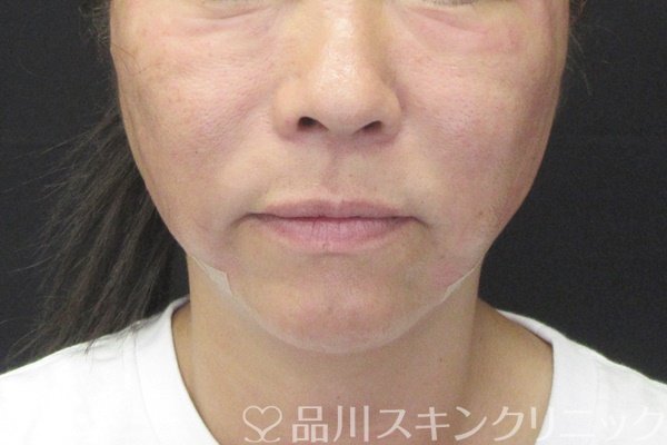 症例NO.65257のAFTER写真