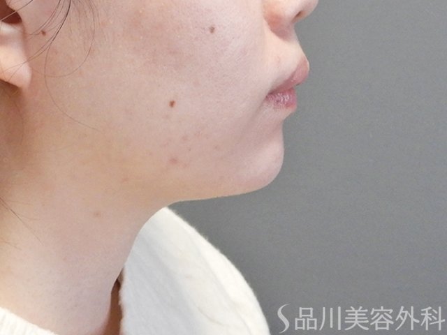 症例NO.67998のAFTER写真