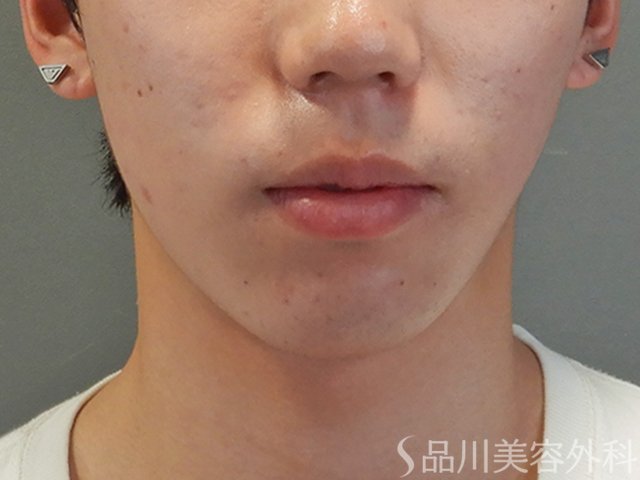 症例NO.74901のBEFORE写真